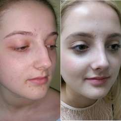 Rhinoplasty