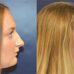 Rhinoplasty